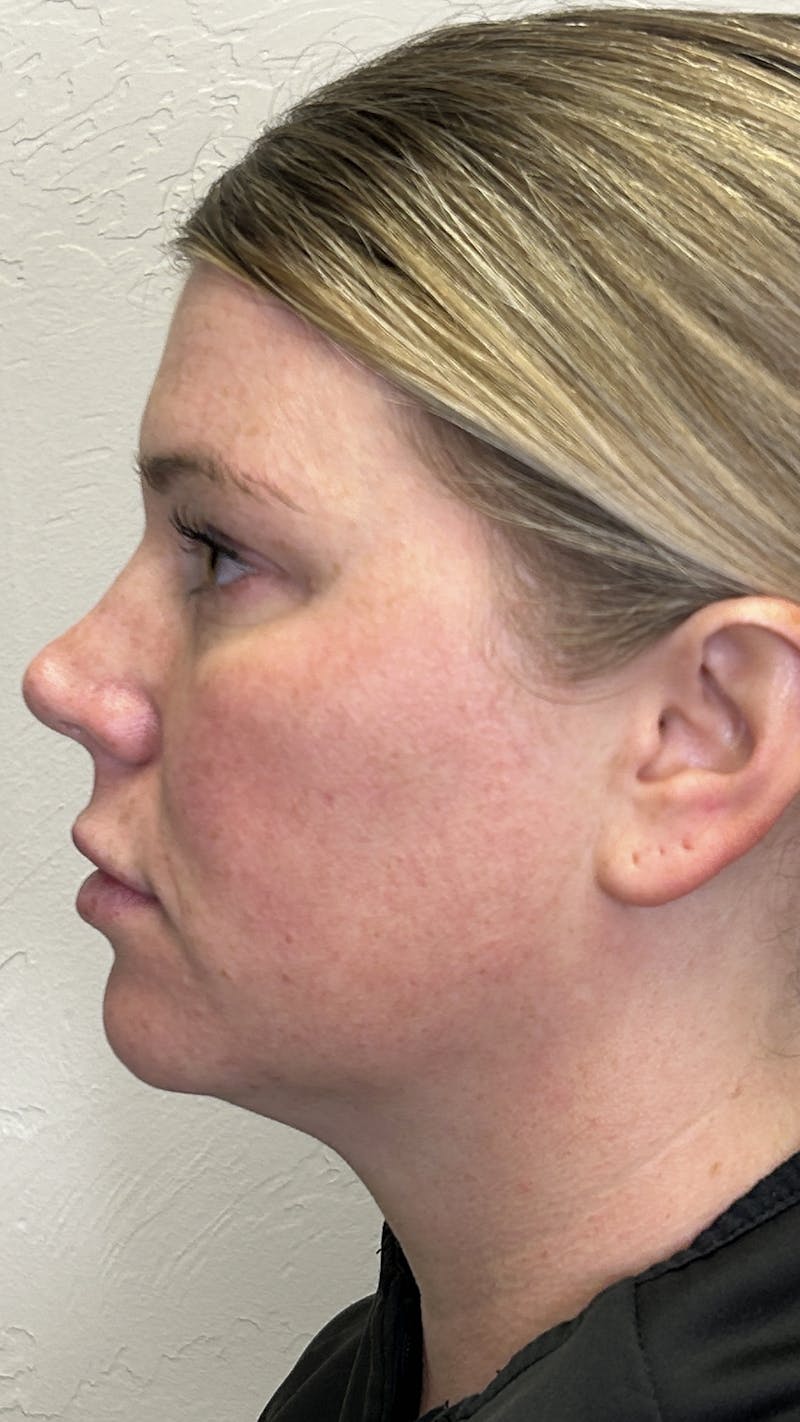Full Face Filler Before & After Gallery - Patient 147739046 - Image 5