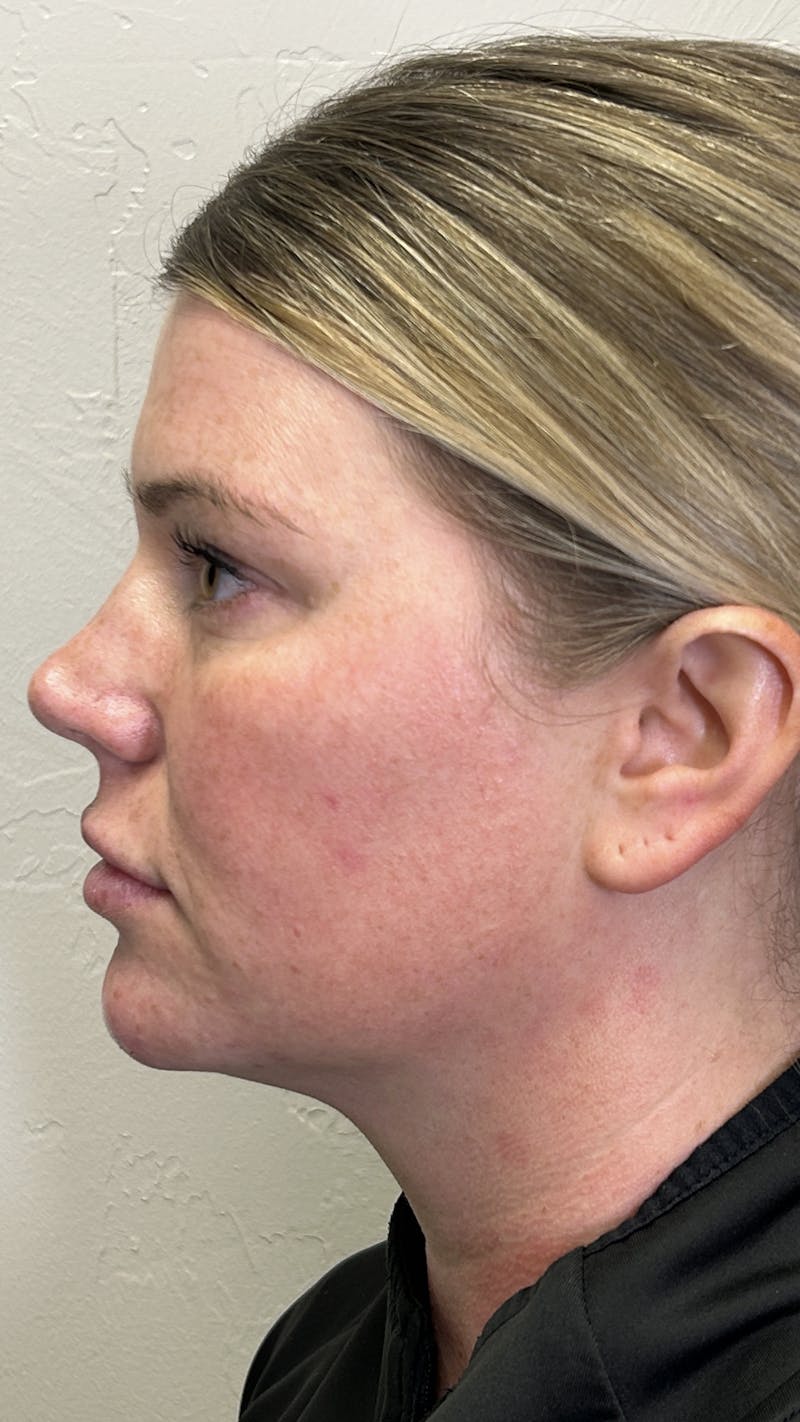 Full Face Filler Before & After Gallery - Patient 147739046 - Image 6
