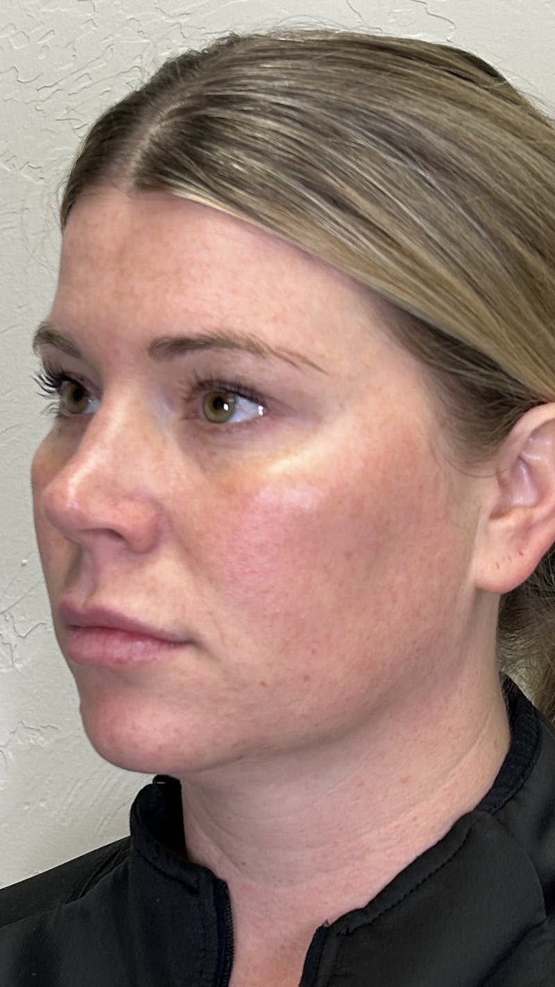Full Face Filler Before & After Gallery - Patient 147739046 - Image 3