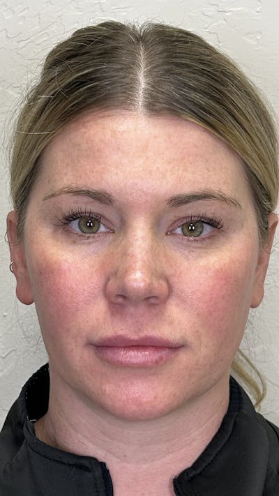 Full Face Filler Before & After Gallery - Patient 147739046 - Image 1