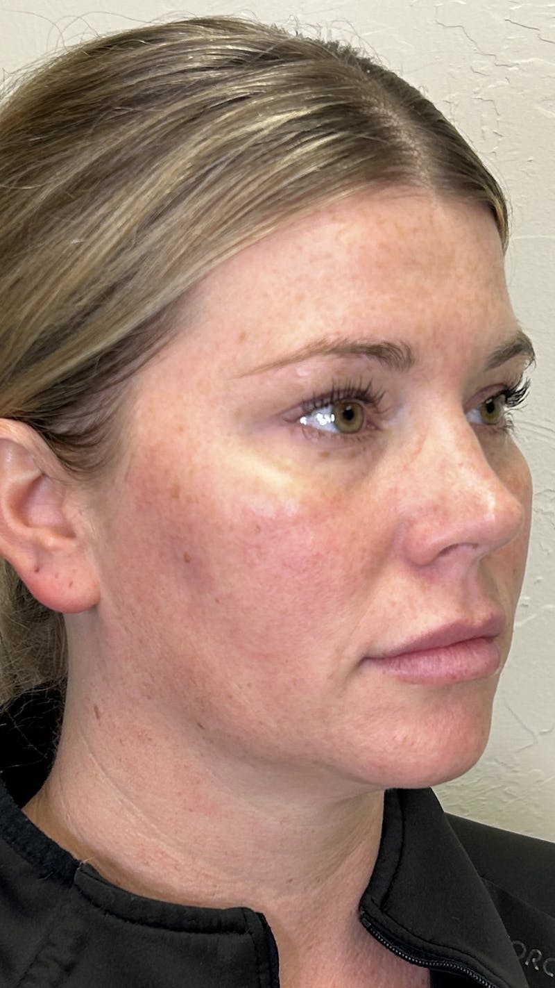 Full Face Filler Before & After Gallery - Patient 147739046 - Image 7