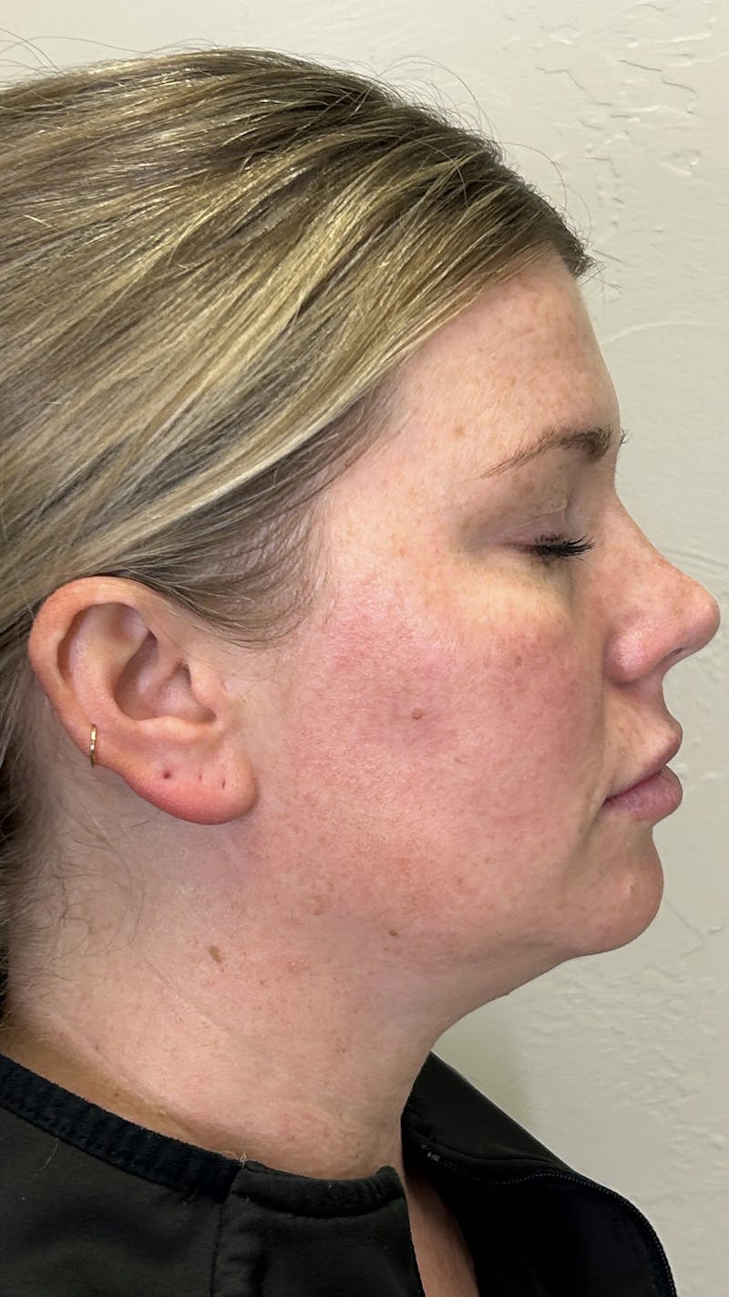 Full Face Filler Before & After Gallery - Patient 147739046 - Image 9