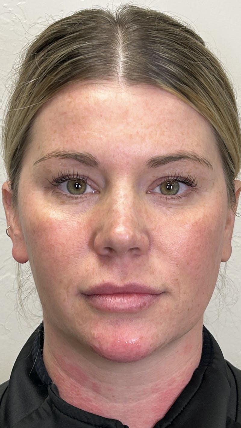 Full Face Filler Before & After Gallery - Patient 147739046 - Image 2