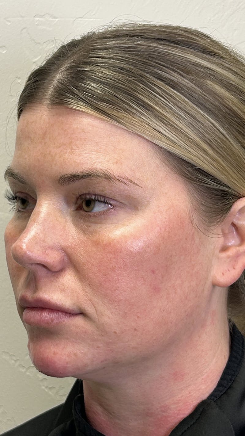 Full Face Filler Before & After Gallery - Patient 147739046 - Image 4