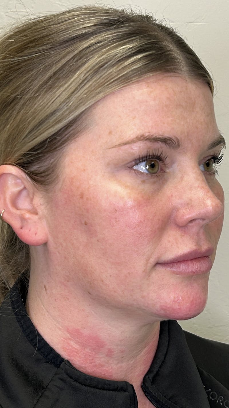 Full Face Filler Before & After Gallery - Patient 147739046 - Image 8