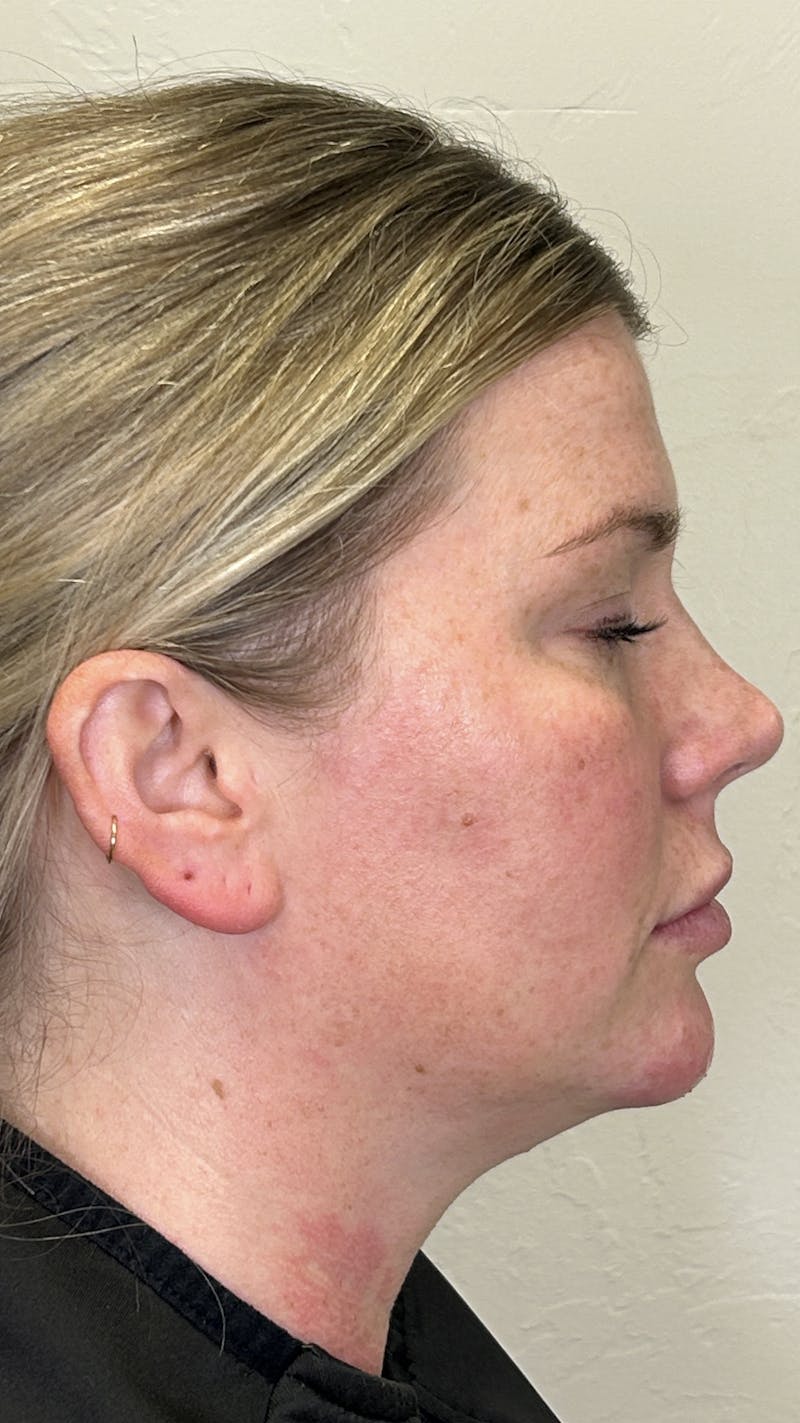 Full Face Filler Before & After Gallery - Patient 147739046 - Image 10