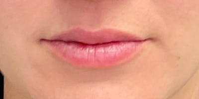 Lips Before & After Gallery - Patient 147740293 - Image 1