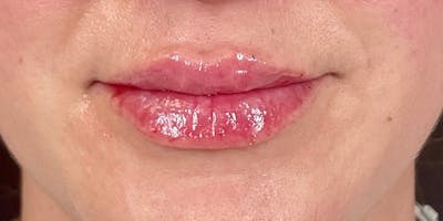 Lips Before & After Gallery - Patient 147740293 - Image 2