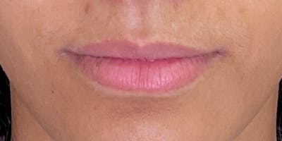 Lips Before & After Gallery - Patient 147703797 - Image 1