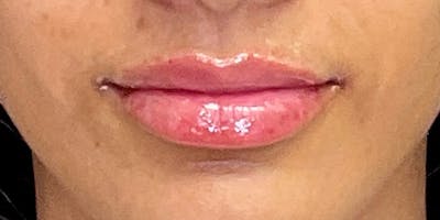 Lips Before & After Gallery - Patient 147703797 - Image 2