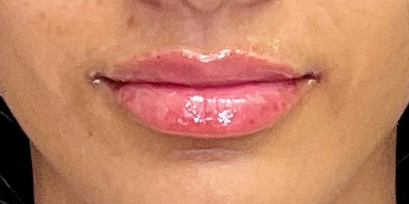 Lips Before & After Gallery - Patient 147703797 - Image 2