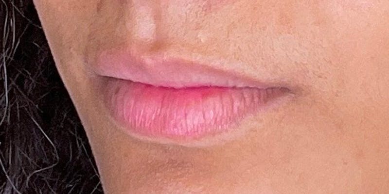 Lips Before & After Gallery - Patient 147703797 - Image 3