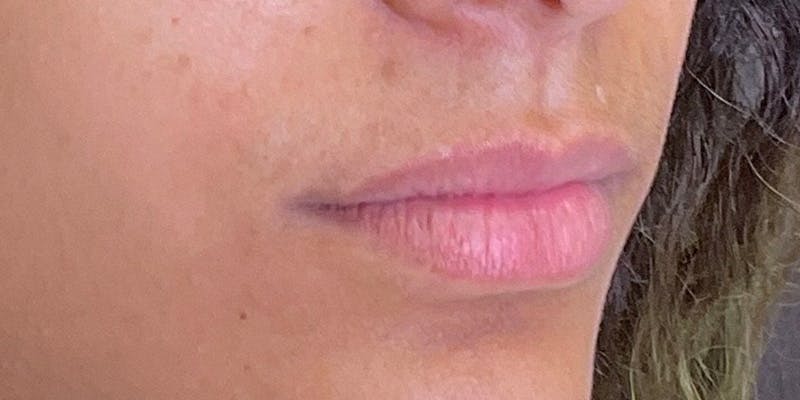 Lips Before & After Gallery - Patient 147703797 - Image 7