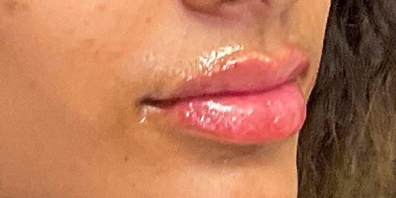 Lips Before & After Gallery - Patient 147703797 - Image 8