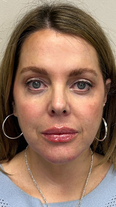 Full Face Filler Before & After Gallery - Patient 148023472 - Image 2