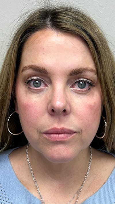 Full Face Filler Before & After Gallery - Patient 148023472 - Image 1