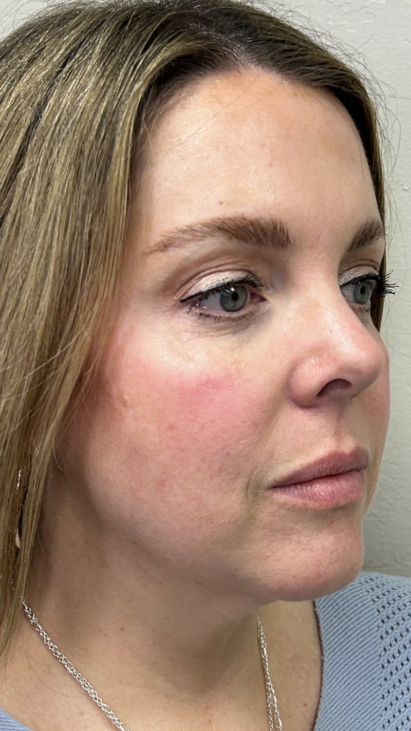 Patient 148023472 Full Face Filler Before & After Photos Highwater