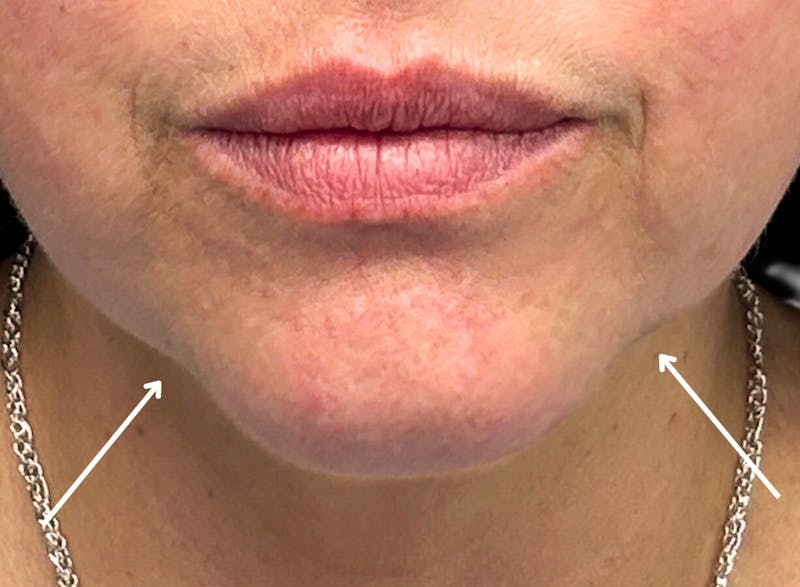 Lips Before & After Gallery - Patient 148023468 - Image 1