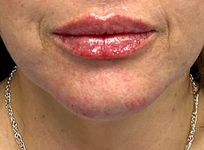Lips Before & After Gallery - Patient 148023468 - Image 2