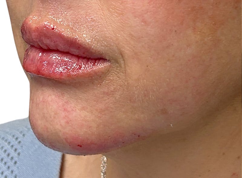 Lips Before & After Gallery - Patient 148023468 - Image 4
