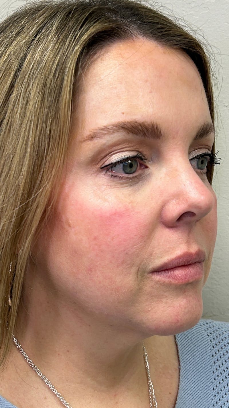 Full Face Filler Before & After Gallery - Patient 148023472 - Image 3