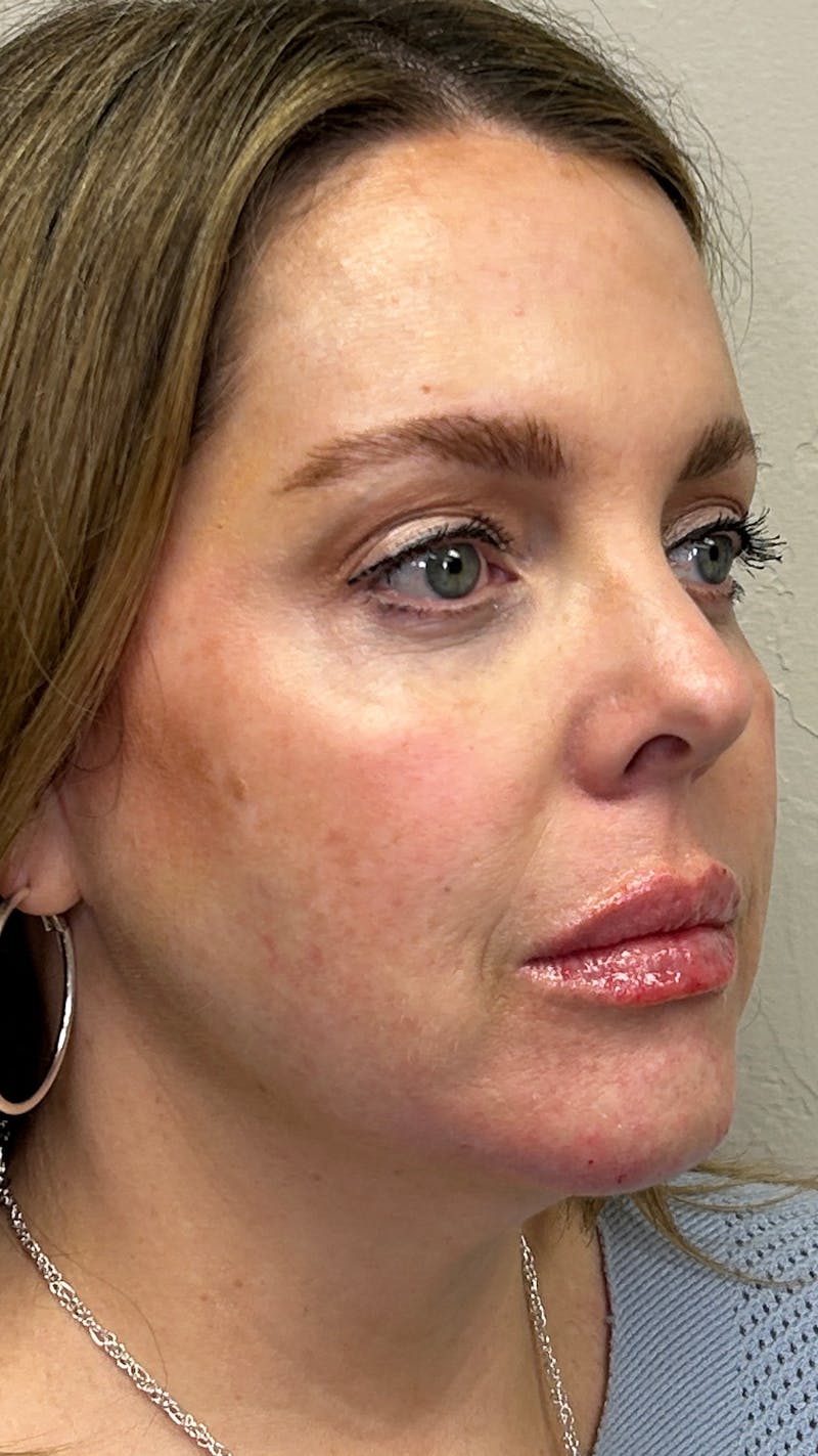 Full Face Filler Before & After Gallery - Patient 148023472 - Image 4