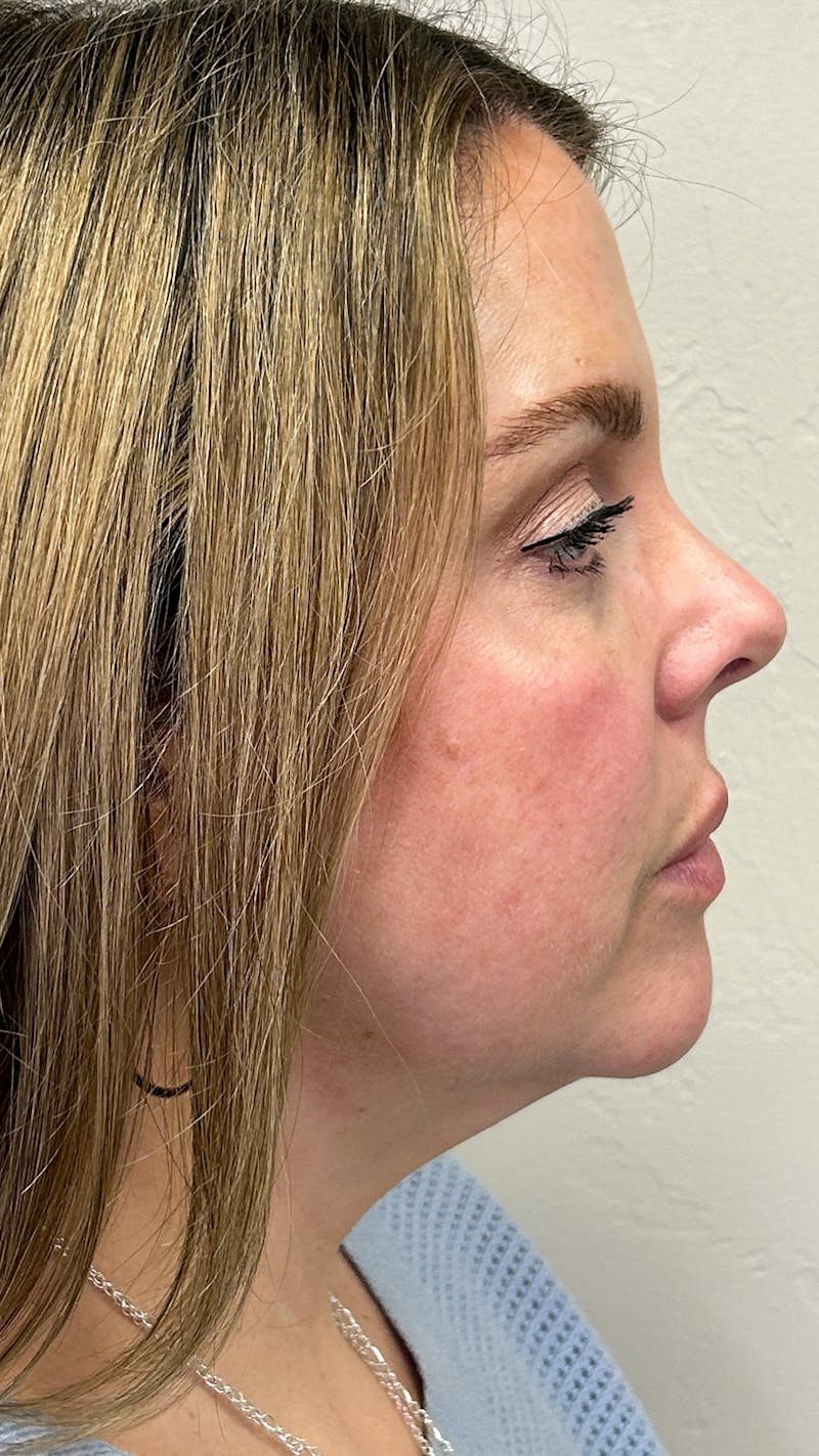 Full Face Filler Before & After Gallery - Patient 148023472 - Image 5