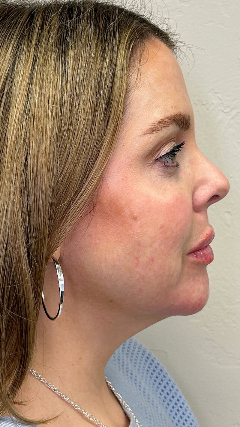 Full Face Filler Before & After Gallery - Patient 148023472 - Image 6