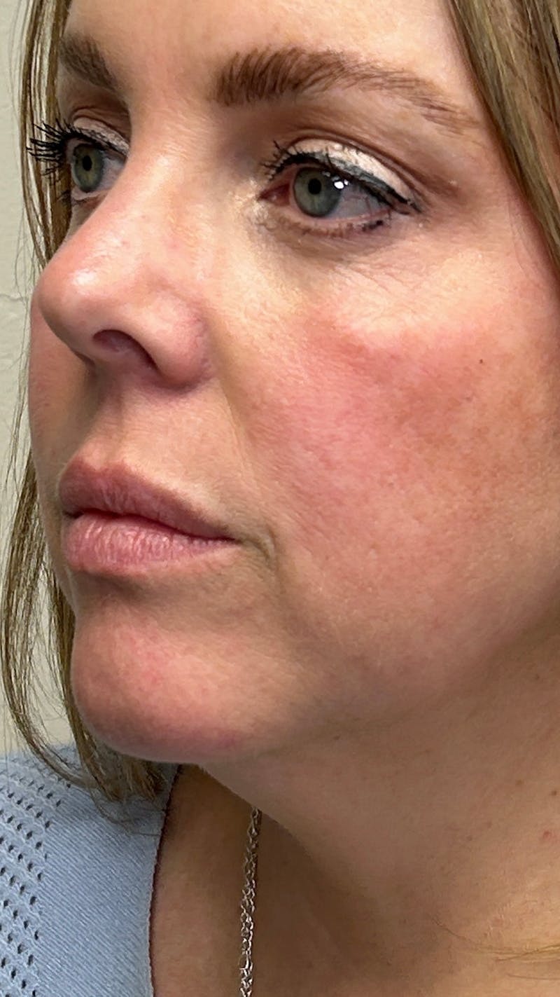 Full Face Filler Before & After Gallery - Patient 148023472 - Image 7