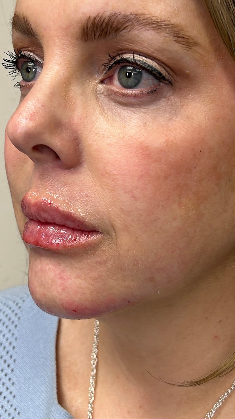 Full Face Filler Before & After Gallery - Patient 148023472 - Image 8