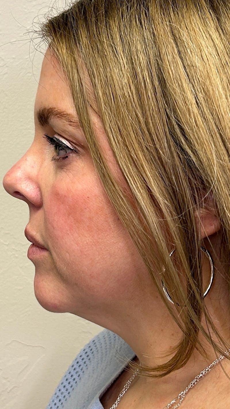Full Face Filler Before & After Gallery - Patient 148023472 - Image 9
