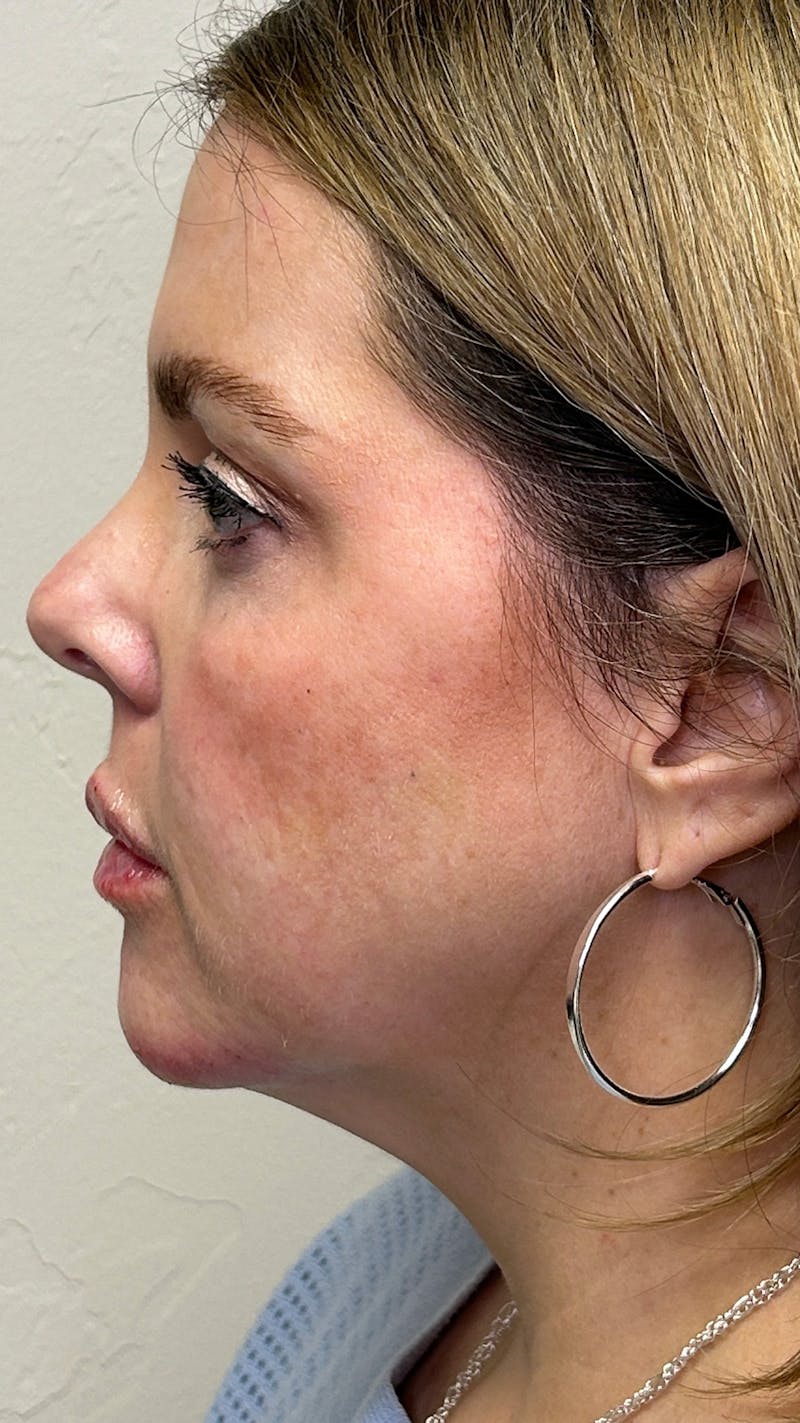 Full Face Filler Before & After Gallery - Patient 148023472 - Image 10