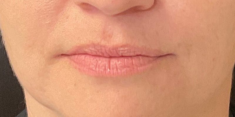 Lips Before & After Gallery - Patient 148539915 - Image 1