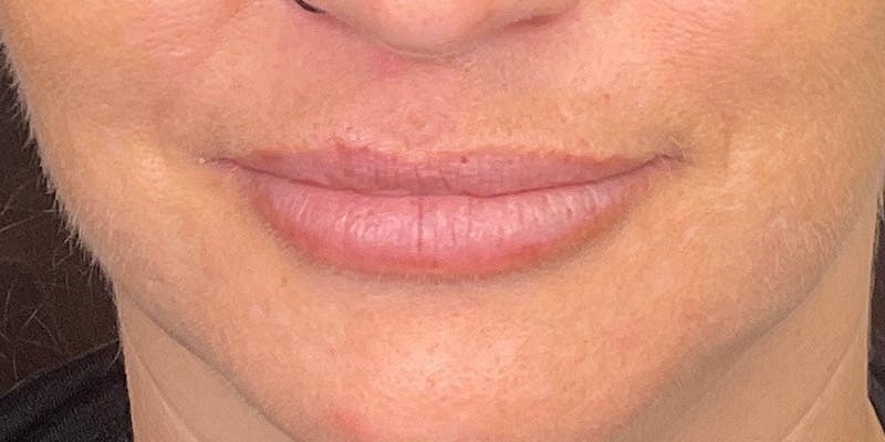 Lips Before & After Gallery - Patient 148539915 - Image 2