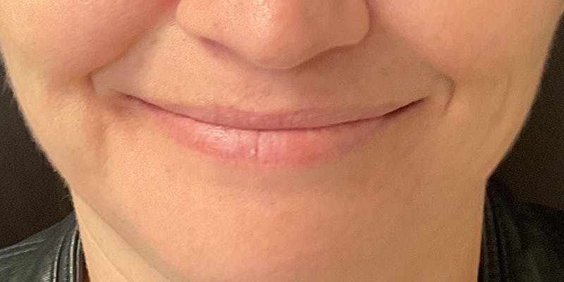 Lips Before & After Gallery - Patient 148539915 - Image 3