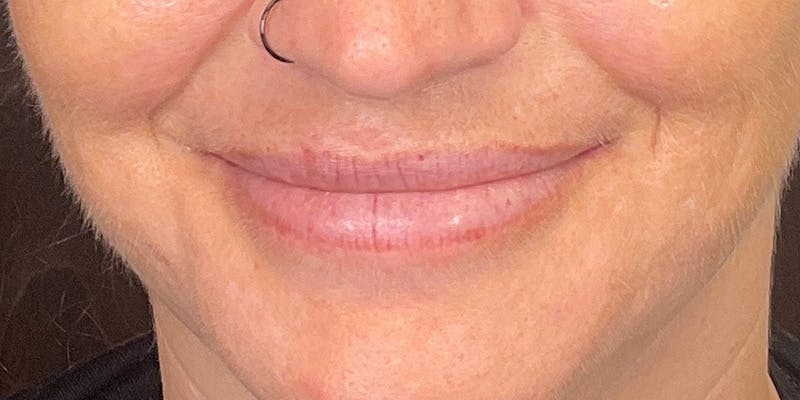 Lips Before & After Gallery - Patient 148539915 - Image 4