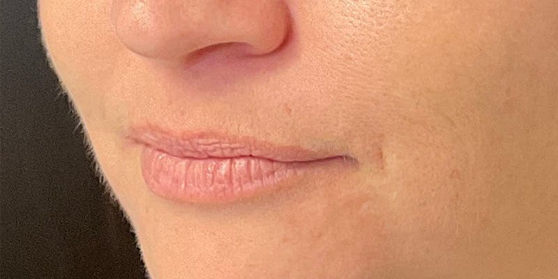 Lips Before & After Gallery - Patient 148539915 - Image 9