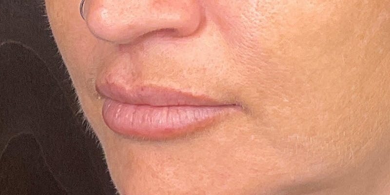 Lips Before & After Gallery - Patient 148539915 - Image 10