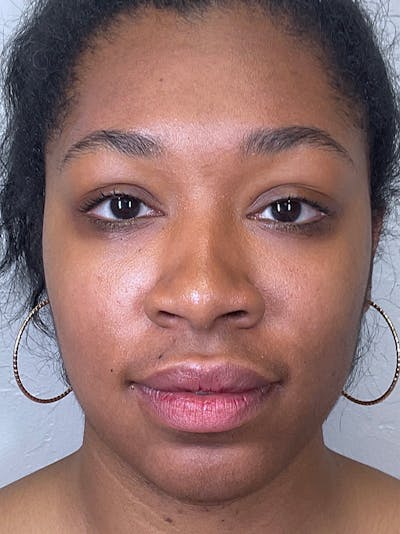 Full Face Filler Before & After Gallery - Patient 148757641 - Image 1