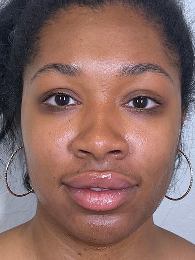 Full Face Filler Before & After Gallery - Patient 148757641 - Image 2