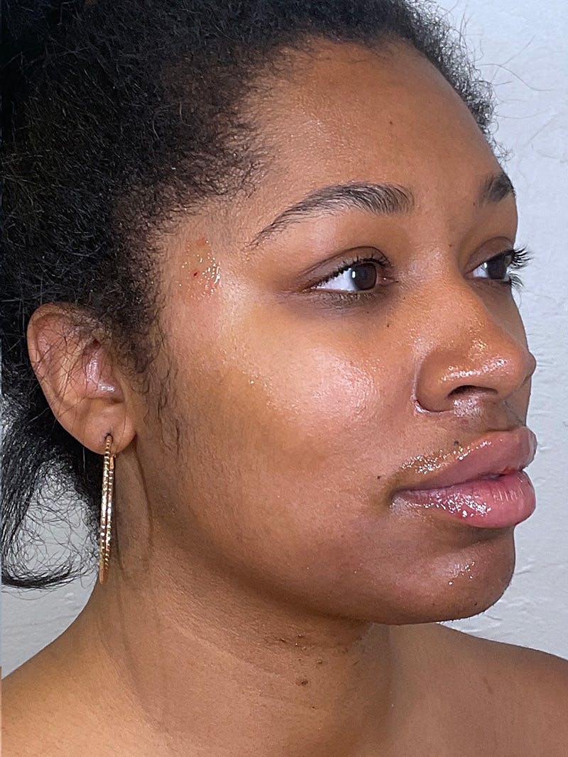 Full Face Filler Before & After Gallery - Patient 148757641 - Image 4