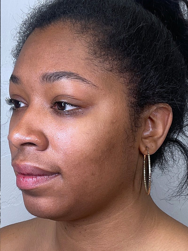 Full Face Filler Before & After Gallery - Patient 148757641 - Image 7