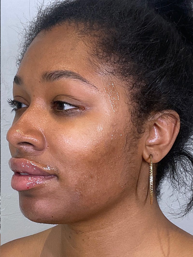 Full Face Filler Before & After Gallery - Patient 148757641 - Image 8
