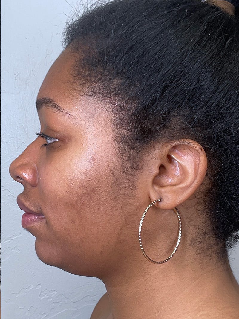 Full Face Filler Before & After Gallery - Patient 148757641 - Image 9