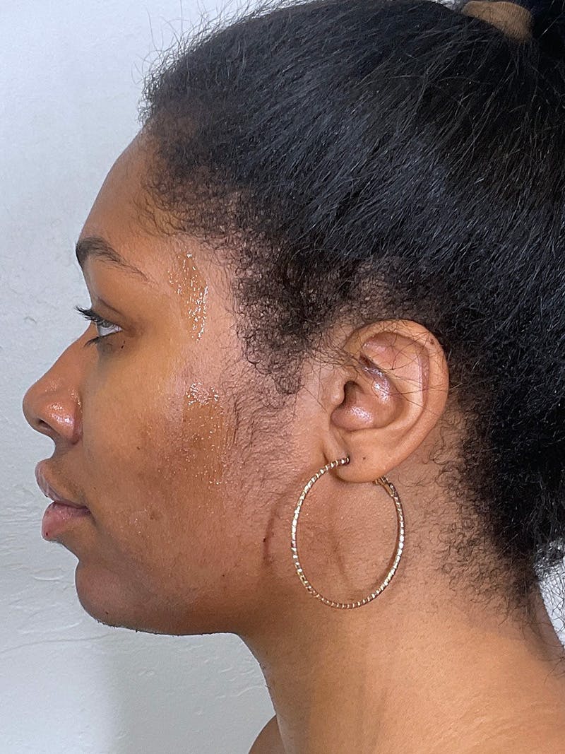 Full Face Filler Before & After Gallery - Patient 148757641 - Image 10