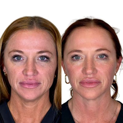 Full Face Filler Before & After Gallery - Patient 121636 - Image 1
