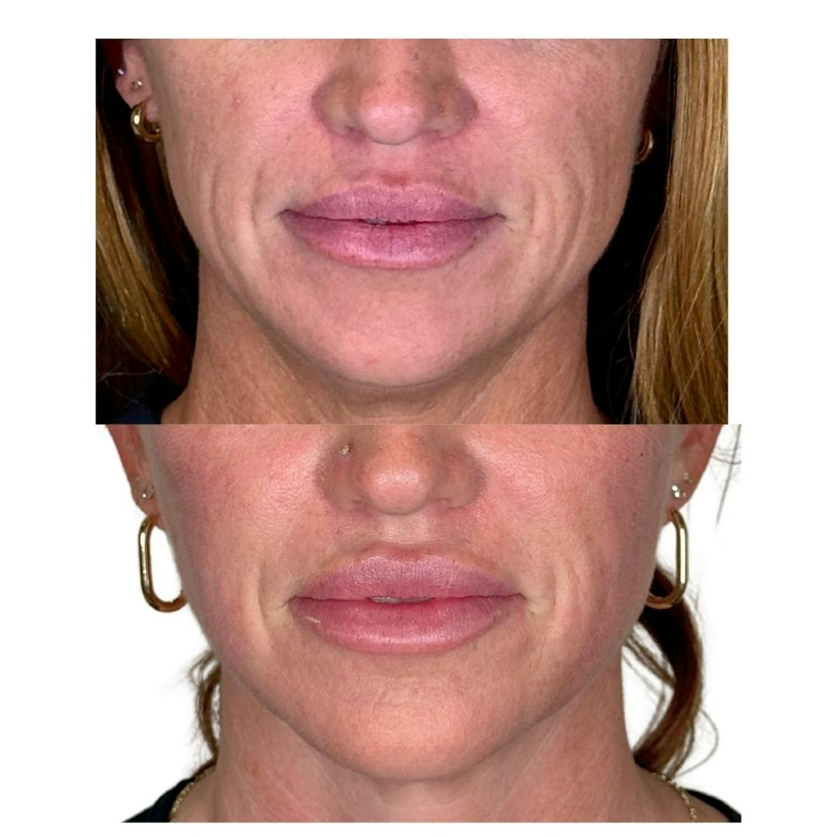 Full Face Filler Before & After Gallery - Patient 121636 - Image 7