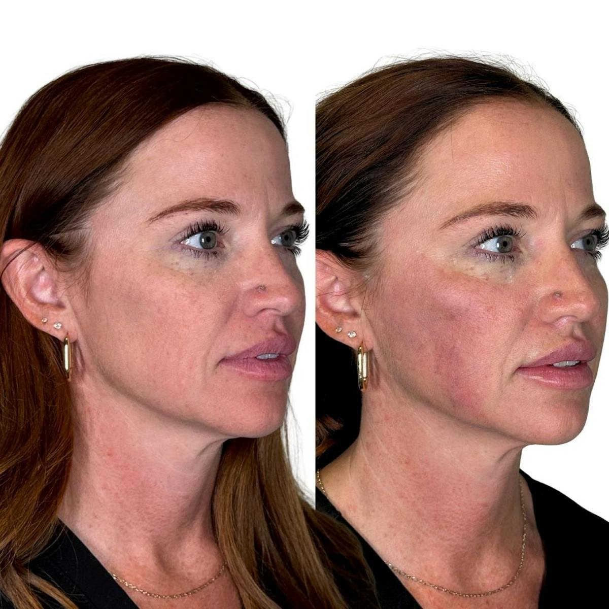 Full Face Filler Before & After Gallery - Patient 121636 - Image 3