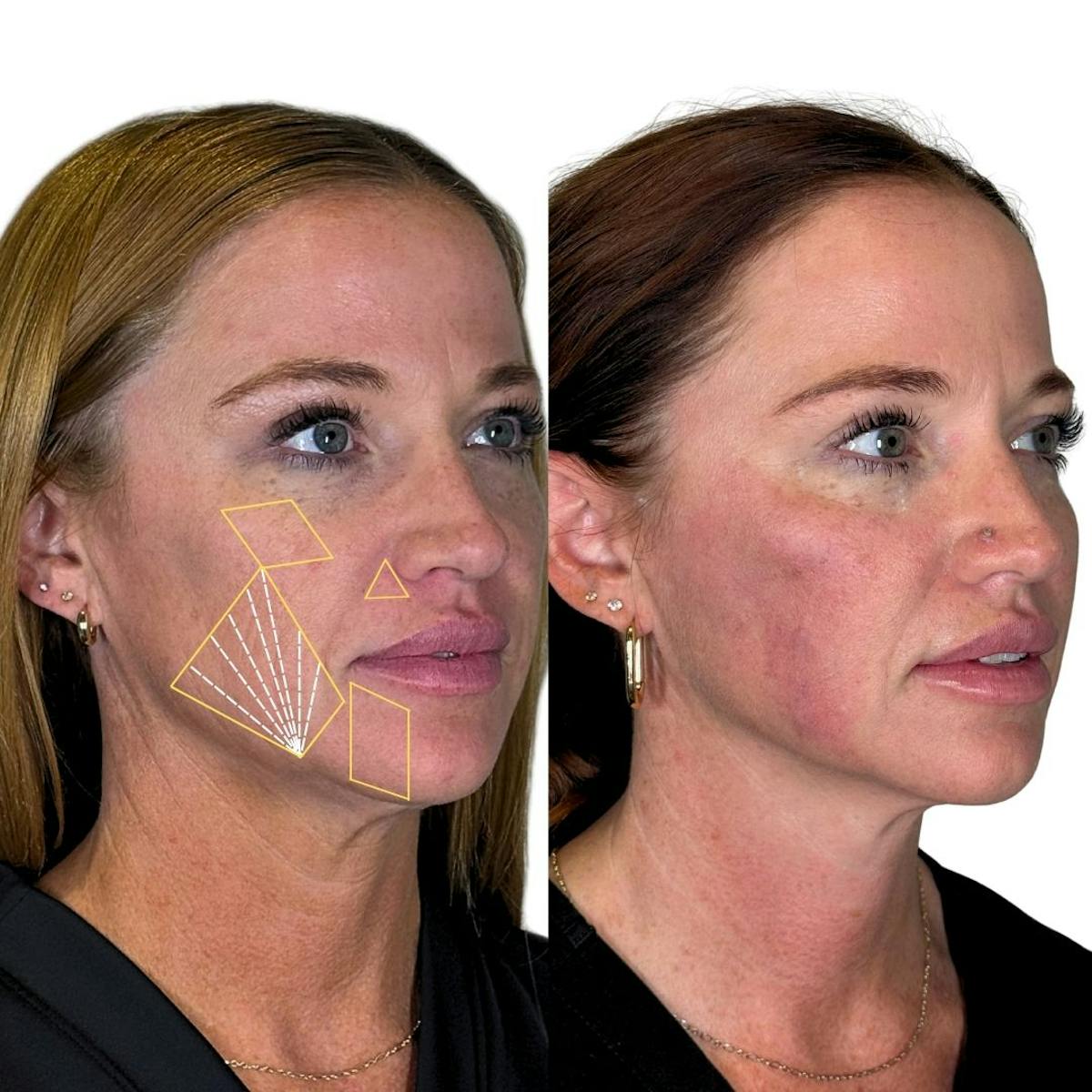 Full Face Filler Before & After Gallery - Patient 121636 - Image 4