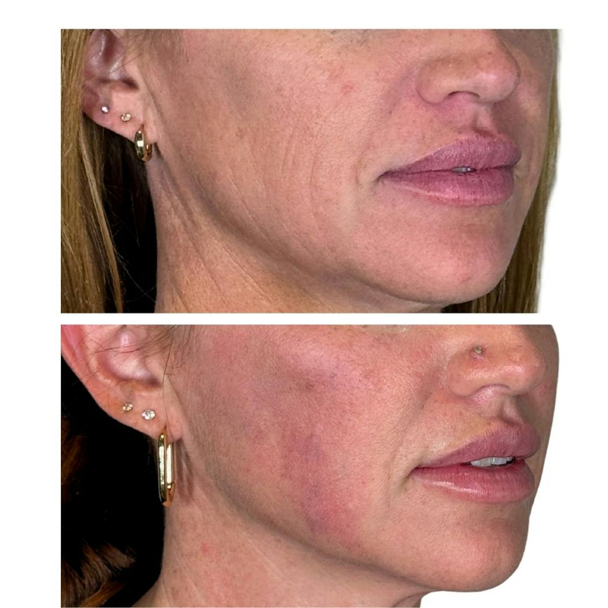 Full Face Filler Before & After Gallery - Patient 121636 - Image 9